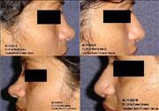 Before After Pictures,Nose job,Rhinoplasty,Delhi